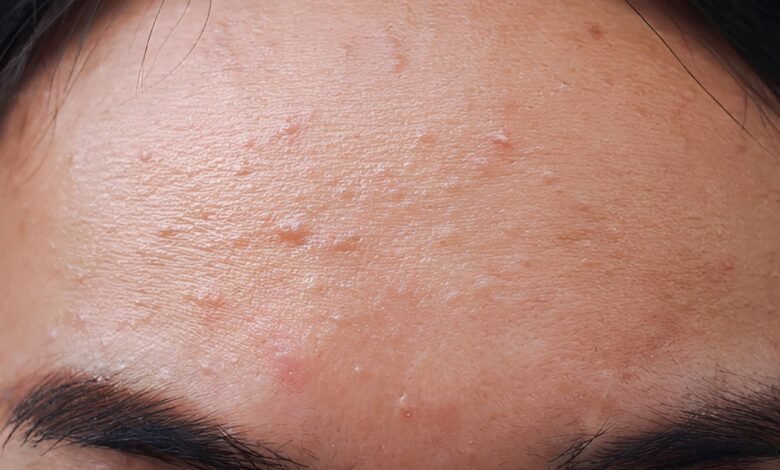 fungal acne on face